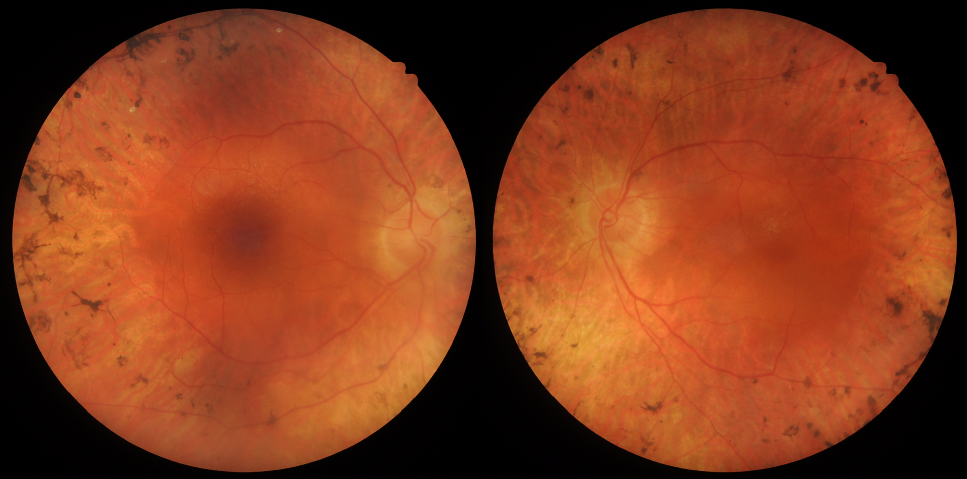 Retinitis Pigmentosa (Extract from the CFEH Atlas) - Centre for Eye Health